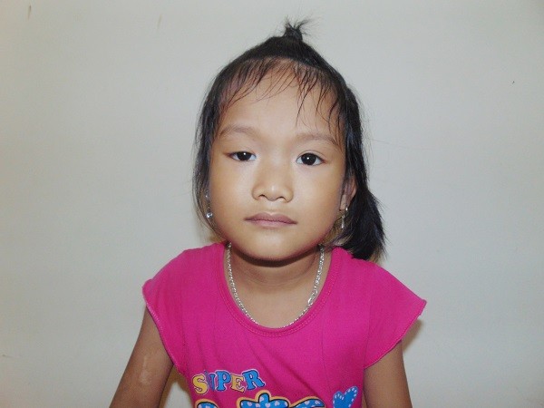 Bệnh nhân bị sụp mí